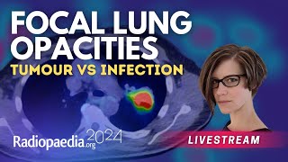 Focal lung opacities tumour vs infection with​ Miranda Siemienowicz [upl. by Najed]