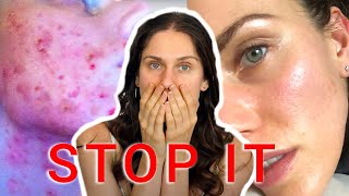 5 Worst Acne Habits STOP DOING THESE [upl. by Edyaw]