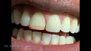 Restaurar correctamente un borde incisal [upl. by Siuraj]