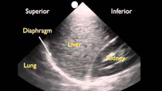 How To Ultrasound Detection of Pleural Fluid Case Study Video [upl. by Novahc]