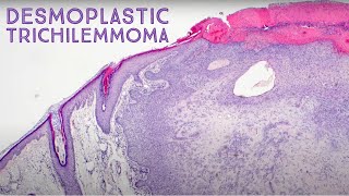 Desmoplastic Trichilemmoma Dermpath in 5 Minutes dermatology pathology dermatopathology [upl. by Forras]