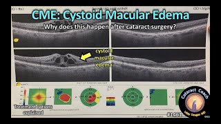 CataractCoach 1461 cystoid macular edema CME after cataract surgery [upl. by Ridgley166]