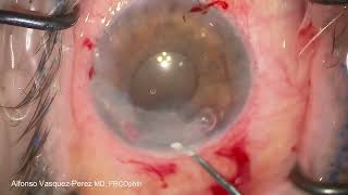 Customised DMEK to treat bullous keratopathy due to iris cyst [upl. by Ssepmet]