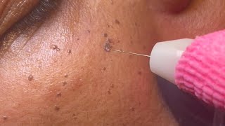 DPN Dermatosis Papulosa Nigra Removal [upl. by Gnilrad624]