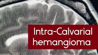 IntraCalvarial hemangioma on MRI scan  osseous venous lowflow vascular malformations mri [upl. by Sinnal]