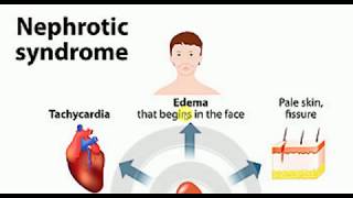 Nephrotic Syndrome  MEDICINE Lectures  NEPHROLOGY  TP 8 [upl. by Ginelle]