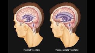 Management of hydrocephalus [upl. by Eenot11]