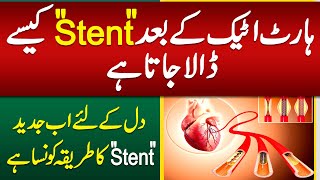 Heart Stent Procedure  Heart Stent Kaise Dalte Hain  Heart Attack Stent Procedure [upl. by Neeli]