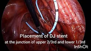 LAPAROSCOPIC URETEROLITHOTOMY FOR LOWER URETERIC STONE [upl. by Letta]