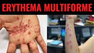 ERYTHEMA MULTIFORME  Triggers Symptoms Diagnosis Treatment  What is Erythema multiforme [upl. by Naes]