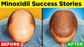 MINOXIDIL  A StepbyStep Guide to Regain Your Hair [upl. by Joub]