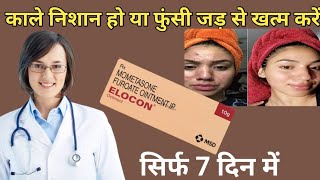 elocon ointment use in hindi mometasone ointment [upl. by Petronia416]