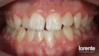 Aparatología fija multibrackets de prescripción RothWilliams  Antes y Después  Lorente Ortodoncia [upl. by Bobbe]