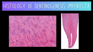 Histology of Dentinogenesis Imperfecta [upl. by Ameen]