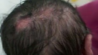 case575 scalp heal atrophic hairless fibrotic aplasia cutis congenita with solitary epidermal naevus [upl. by Arianna928]