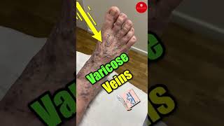 Varicose Veins Symptoms and Treatment [upl. by Norvun]