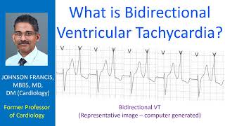 What is bidirectional ventricular tachycardia [upl. by Strader]