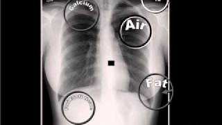 01 The 5 Basic Radiographic Densities [upl. by Preston]