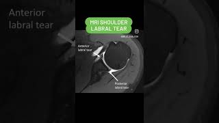 Labral Tear MRI shoulder joint shorts viral youtubeshorts [upl. by Adle]