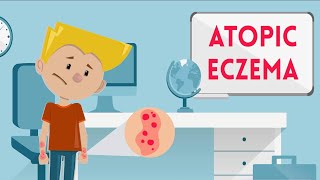 Atopic Eczema [upl. by Enirolf]