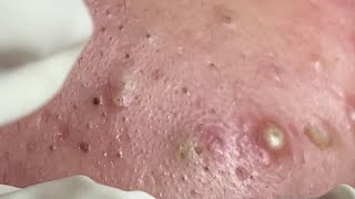 Make your Acne Treatment Huong Da Nang  423  acne 2022 [upl. by Yssenhguahs]