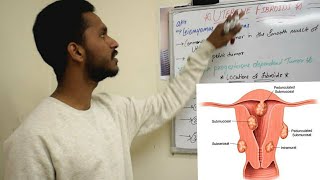 UTERINE FIBROID  SHORT REVIEW  MEDDY SIMPLIFIED  OBG [upl. by Eleda]