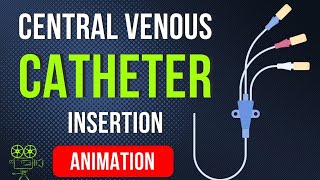 🎬 CENTRAL VENOUS CATHETER CVC INSERTION PROCEDURE  ANIMATED EXPLANATION [upl. by Elrem]