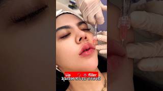 lip filler [upl. by Yordan]