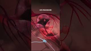 What is Uterine Fibroid Embolization procedure Types of Fibroids fibroid pregnancy animation [upl. by Adok]