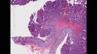 Histopathology Colon Tubular adenoma adenomatous polyp [upl. by Frodina]