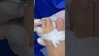 Extracción de matriz satisfying ingrowntoenailsurgery [upl. by Anasor]