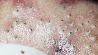 Big Cystic Acne Blackheads Extraction Blackheads amp Milia Whiteheads Removal Pimple Popping  327 [upl. by Frear]