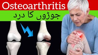 Osteoarthritis in HindiUrdu Symptoms Causes and Treatmentquot ऑस्टियोआर्थराइटिस [upl. by Enyale]