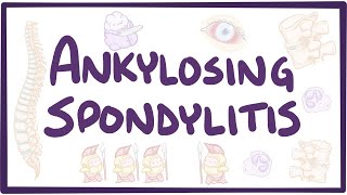 Ankylosing spondylitis  causes symptoms diagnosis treatment pathology [upl. by Burk]