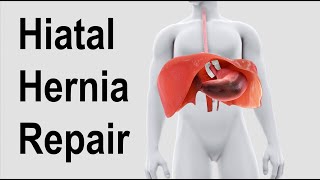 Hiatal Hernia Repair Animation [upl. by Acsisnarf189]