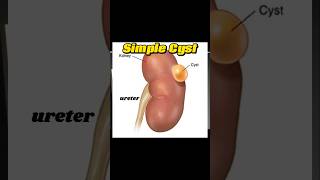 Renal Cyst  Simple Kidney Cyst  Cyst  Fluid Filled  Kidney Ultrasound [upl. by Oigolue376]