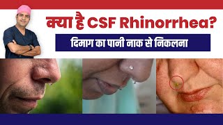 CSF Rhinorrhea क्या है  Jaane kya ha CSF Rhinorrhea ka bare ma  Dr Sunil Tanvar [upl. by Euqinor]