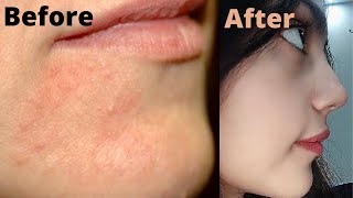 How i got rid of my Perioral Dermatitis and Steroidal acne on face  Get rid of Rosacea permanently [upl. by Alaik]