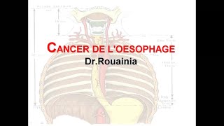 Canser de loesophage  Dr Rouainia [upl. by Estey10]