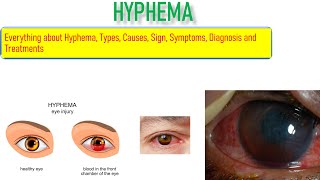 Hyphema Sign Symptoms Causes Risk factor and Treatment Everything is covered in this video [upl. by Anelis464]