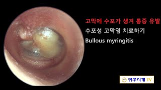 Bullous myringitis 수포성 고막염 [upl. by Cailean]