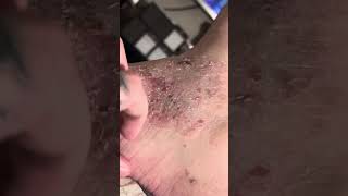 Eczema psoriasis asmr scratching 2 [upl. by Oznerol]