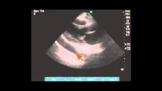 Differentiating pleural vs pericardial effusion by anatomy on echo [upl. by Demahom]