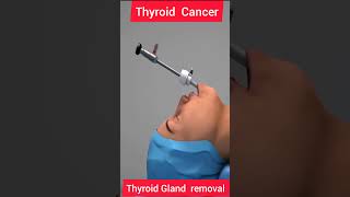 THYROID CANCER  THYROID REMOVAL 3D ANIMATION biologyislife howtogetsuccessinlife getsuccess [upl. by Shaddock]