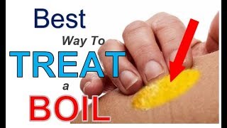 The BEST Way to TREAT a Boil 3 Simple Steps  Best REMEDY for Treating Boils FAST [upl. by Ttenneb]