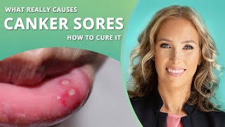 Canker Sores  How to Get Rid of Canker Sores  Dr J9 Live [upl. by Einnig]