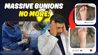 Minimally Invasive Bunion Surgery Patient Tells All [upl. by Burny904]