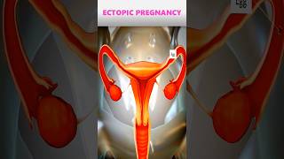 Ectopic pregnancypregnancy pregnancyjourney [upl. by Finbur]