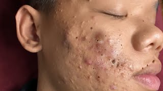 Make your Acne Treatment Huong Da Nang  448 Hoang Part 3  acne 2022 [upl. by Clorinda]