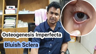 Osteogenesis Imperfecta  Bluish Sclera  Dr Abdullah Al Rafi [upl. by Nashom326]